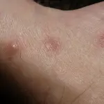 Scabbia: sintomi, cura e prevenzione