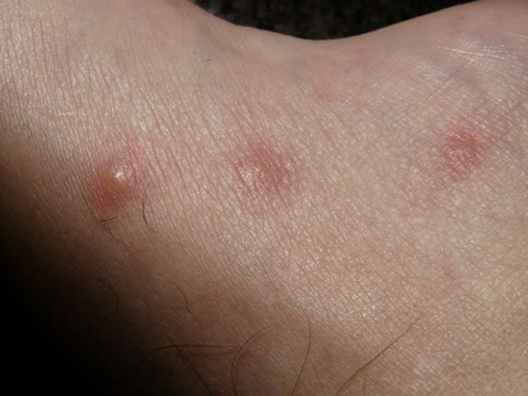 Scabbia: sintomi, cura e prevenzione