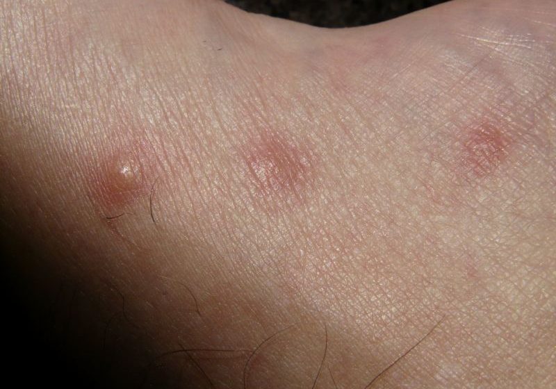 Scabbia: sintomi, cura e prevenzione Scabbia: sintomi, cura e prevenzione